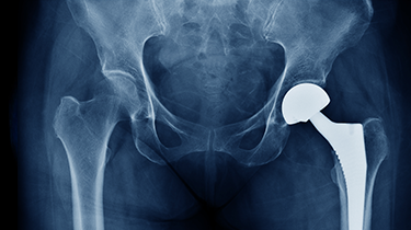 hip surgery.png hip surgery